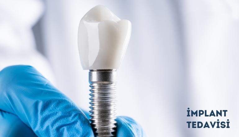 Your Implant Treatment Guide
